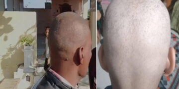बुलढाण्यातील लोक अचानक टकले का झाले? अखेर झाला उलगडा
